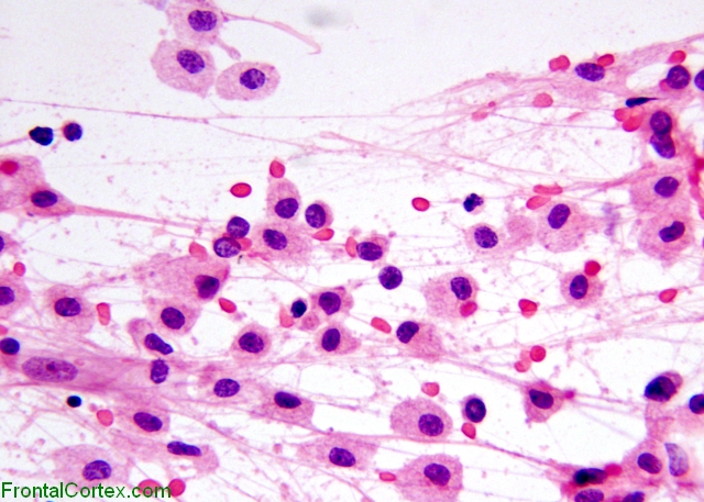 Tumefactive demyelination, intraoperative crush preparation